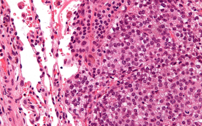 Xstrahl in Action: Sensitizing ewing sarcoma to chemo- and radiotherapy by inhibition of DNA-repair enzymes