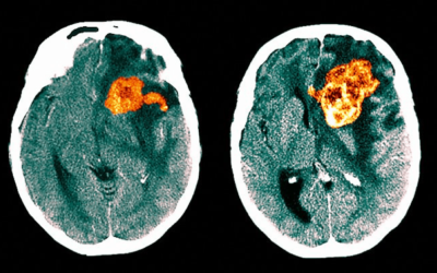 Xstrahl in Action: SARRP Used for Research into PET Inclusion for Treatment of Glioblastomas