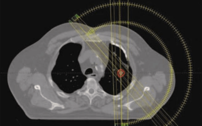 Xstrahl in Action: SARRP used in lung stereotactic arc therapy study