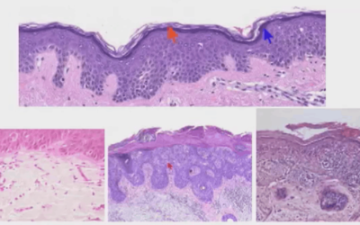 Xstrahl in Action: Multi-Disciplinary Management of Non-Melanoma Skin Cancer